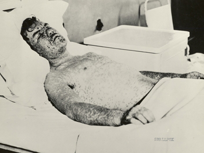 A man who caught smallpox in Milwaukee is shown in this 1925 photo.