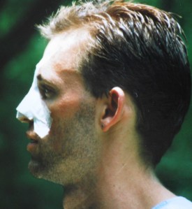 This is how I looked shortly after my nose was broken and then reset in July 1993.